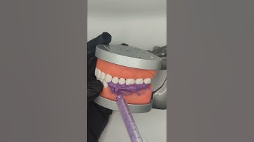 6 - Mounting casts with an edentulous distal extension