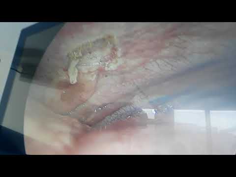 Biopsie pleurale par vts