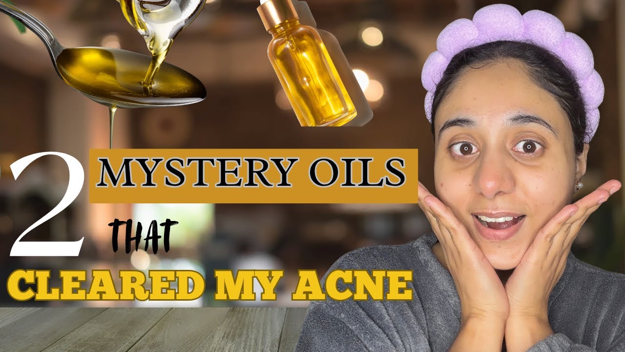 I Used These Face Oils on Acne Skin & THIS Happened! 😱 || Non-Comedogenic & Safe 🌿