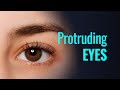 PROTRUDING EYES - What is my eye shape?