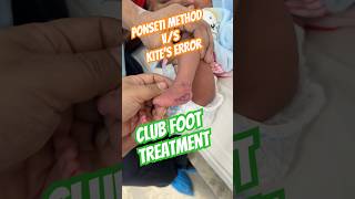 Clubfoot (CTEV)treatment| Kite’s error| Club Foot deformity| Ponseti method #clubfoot #ctev #ponseti