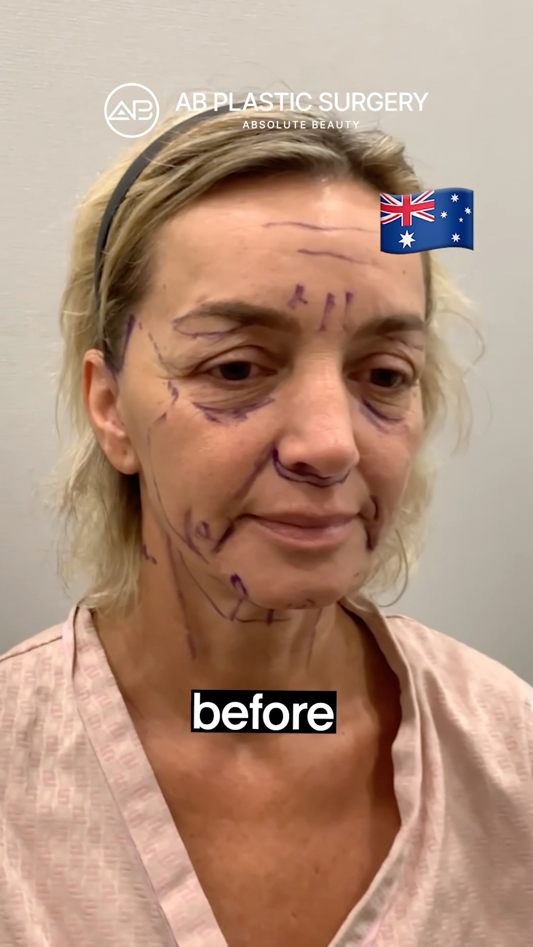 Korean Facelift Changed Her Completely #koreanplasticsurgery