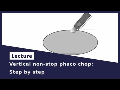 Vertical non-stop phaco chop: step by step