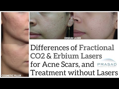 How Certain Types of Acne Scars are Treated with Different Lasers, and Non-Heat Treatments