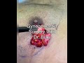 Dr blaus cutting edge gynecomastia surgical technique on a 30 year old from california