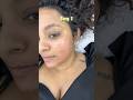 Shocking Skin Transformation in 7 DAYS😱🤯 #Skincare #transformation