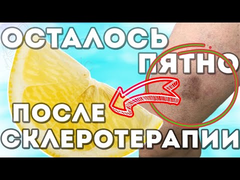 Пигментные пятна после СКЛЕРОТЕРАПИИ?