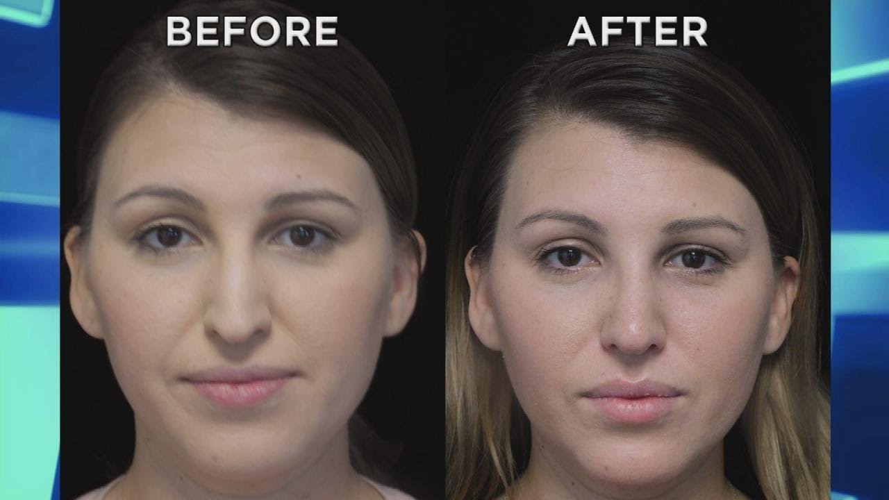 Woman Debuts New Nose after ScarFree Rhinoplasty YouTube