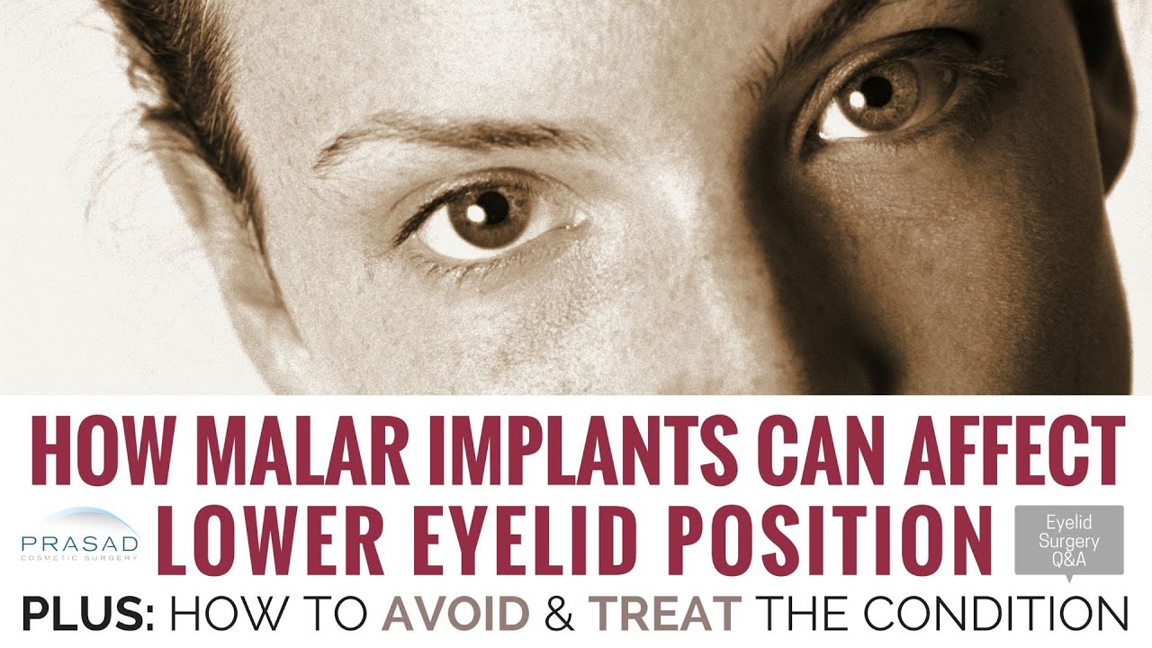 How Eyelid Shape Can be Affected by Malar Implant Removal, and How to