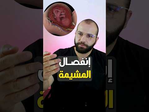 إنفصال المشيمة تثقيف حواء د ضياء فهمى معامل قرطبة