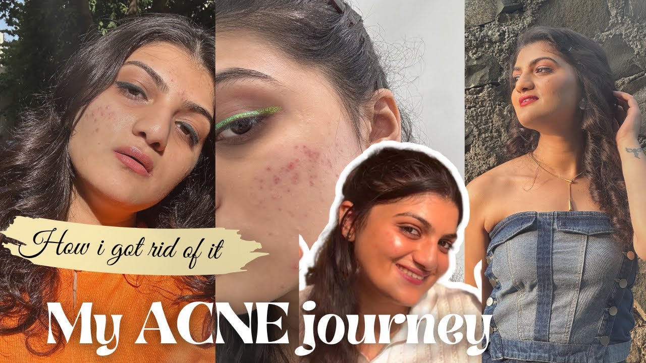 My Acne Journey how i managed to clear it - YouTube