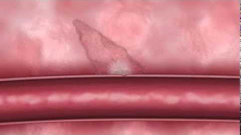 MynxGrip Vascular Closure Device - Animation