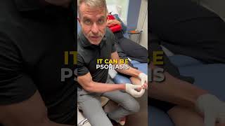 Nail Fungus Among Us #nails  #nailfungustreatment  #onychomycosis #sullivandermatology