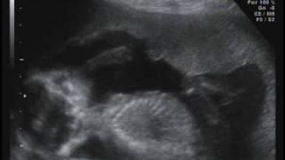 18 Semanas De Gestação - Déia