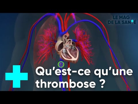 Vidéo: Où se développent la plupart des thrombi ?