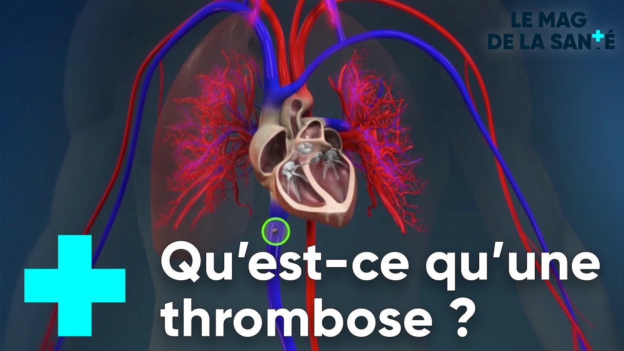 Phlébite au mollet ? Les 6 symptômes les plus fréquents.