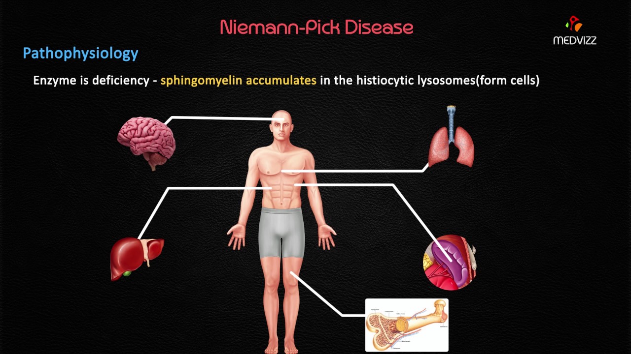 Niemann Pick Disease Type C - Symptoms, Causes, Treatment