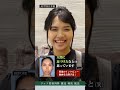 口元の突出を改善したくて手術に挑んだ20代女性!1年後の変化は?