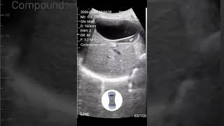 Splenic Sludge Detection with Sono Mobile™ CL64 | Wireless POCUS Ultrasound at the Bedside