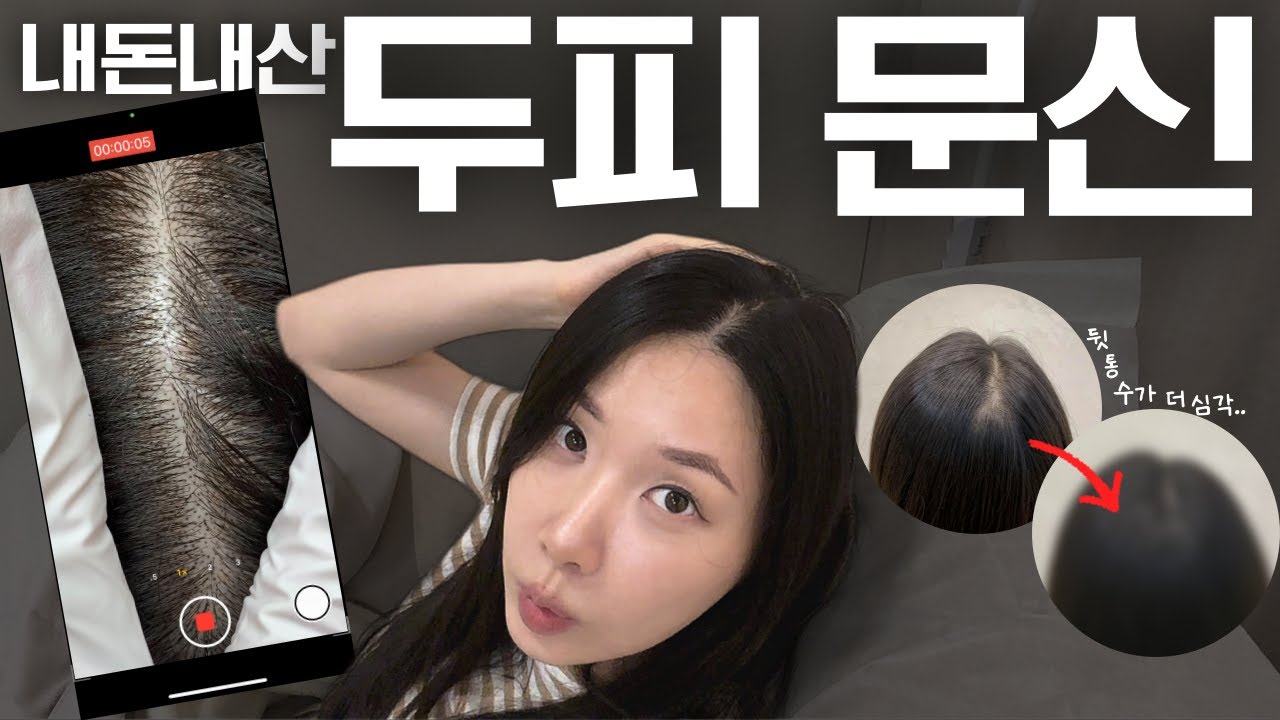 모발이식하려다 받은 '두피문신' 솔직 후기 (대받녀)