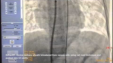 DrRaviRT - Perimembranous VSD Device closure using ADO device - Step by step technique
