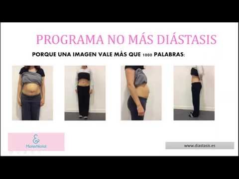 que es diastasis del musculo