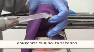 Class IV Direct Composite Restoration #dentalprocedure #diesforum2015
