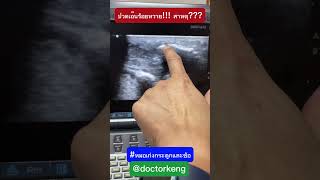 ปวดเอ็นร้อยหวาย สาเหตุ โดยหมอเก่งกระดูกและข้อ#ปวดข้อเท้า #ปวดเอ็นร้อยหวาย #ปวดส้นเท้า