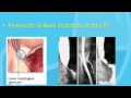 Treatment of Achalasia