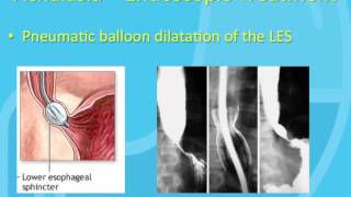 Treatment of Achalasia