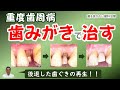 歯周病、歯みがきで治す：後退した歯ぐきがもとに戻る！！！