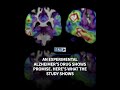 An experimental Alzheimer’s drug shows promise. Here’s what the study shows
