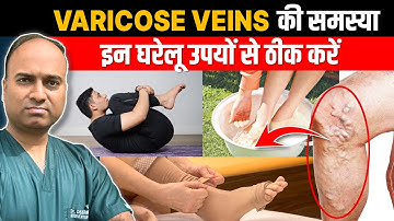 इन 3 तरीकों से घर पर ही Varicose Veins ठीक करें | Varicose Veins Treatment at Home (in Hindi)