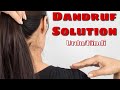 Dandruf Solution Urdu / Hindi | Dandruf Treatment At Home | DFL