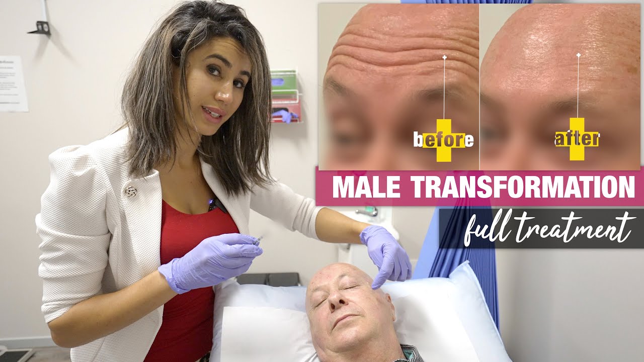 Upper Face Anti-Wrinkle Male Transformation | Full Treatment with Before and After 💉