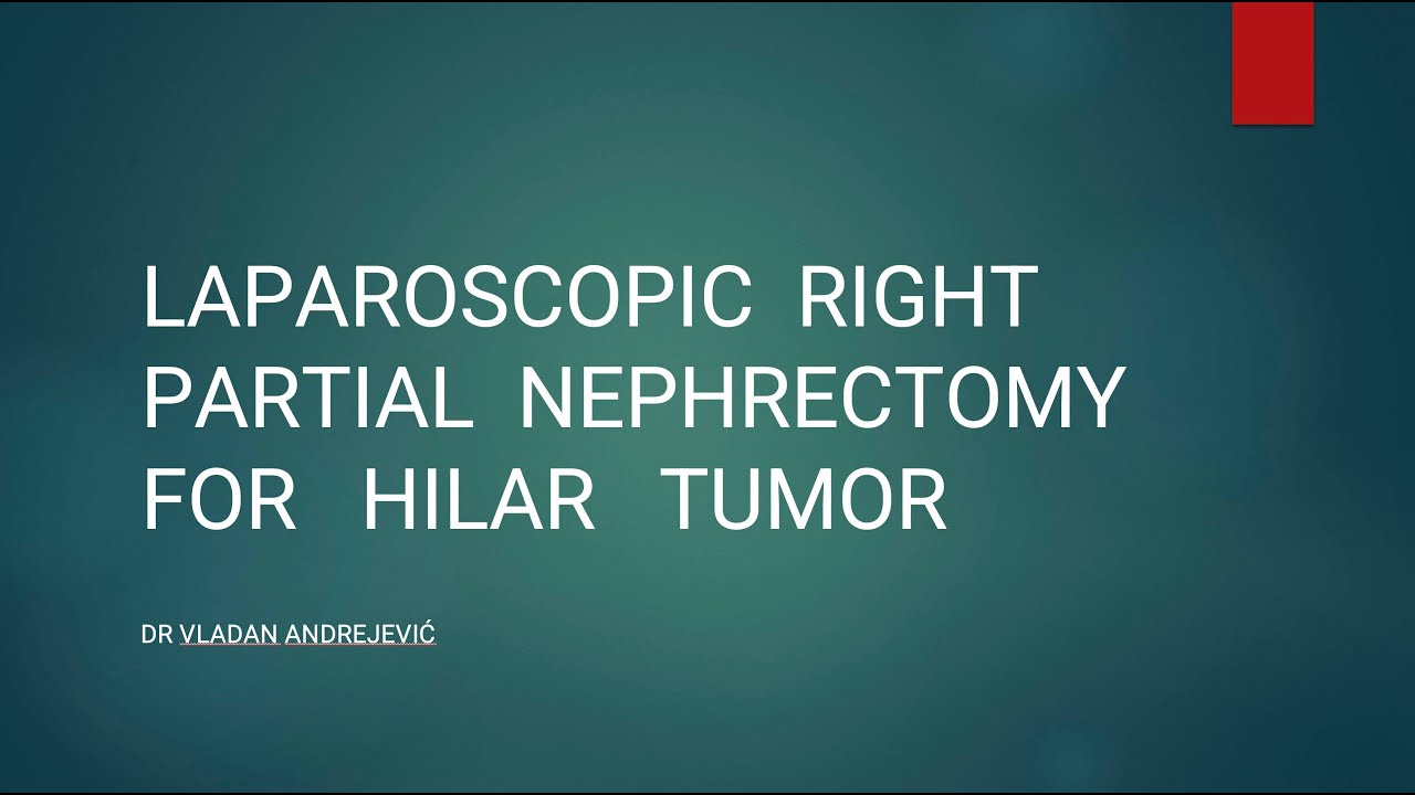 LAPAROSCOPIC RIGHT PARTIAL NEPHRECTOMY FOR HILAR TUMOR dr Vladan ...