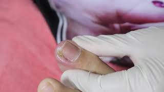 Ep_3193 Ingrown toenail removal 👣 โชคดี..ไม่เป็นตรงโคน 😷 (This clip is from Thailand)