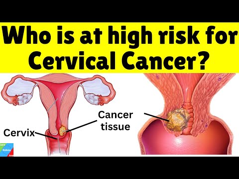 Who is at high risk for Cervical Cancer? | What are the risk factors of Cervical Cancer?