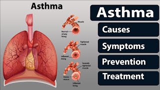 Asthma: Causes, Symptoms, Prevention, and Treatment