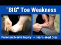 Big Toe Weakness: Peroneal Nerve Palsy vs. L5 Nerve Root Compression