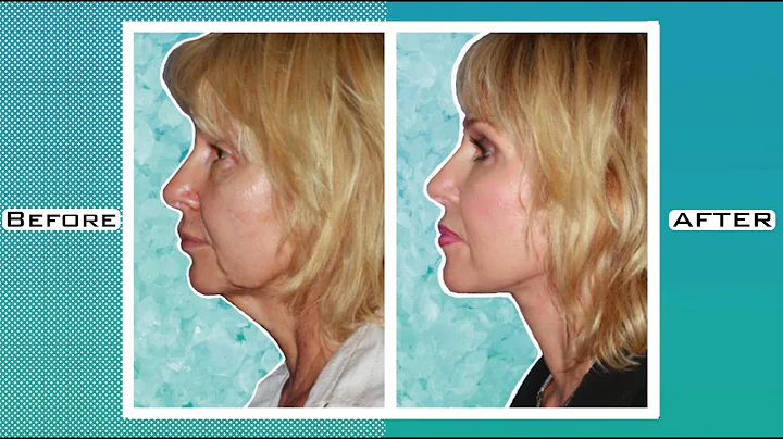 LIFE CHANGING FACELIFT AT 50 | DR. KONSTANTIN
