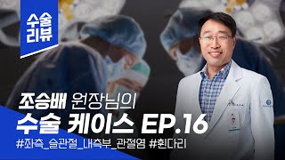 [수술 사례] 조승배 원장님의 수술 케이스 소개 ep.16 관절염, 휜다리