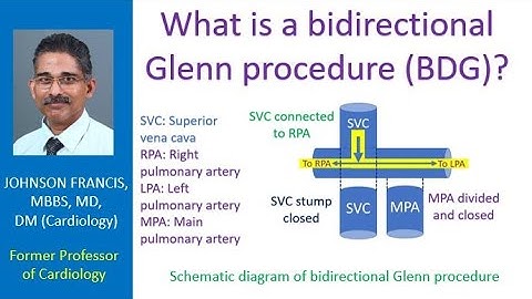 What is a bidirectional Glenn procedure (BDG)?