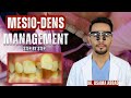 Mesio-dens management Step by step || Dr. Osama Abbad 