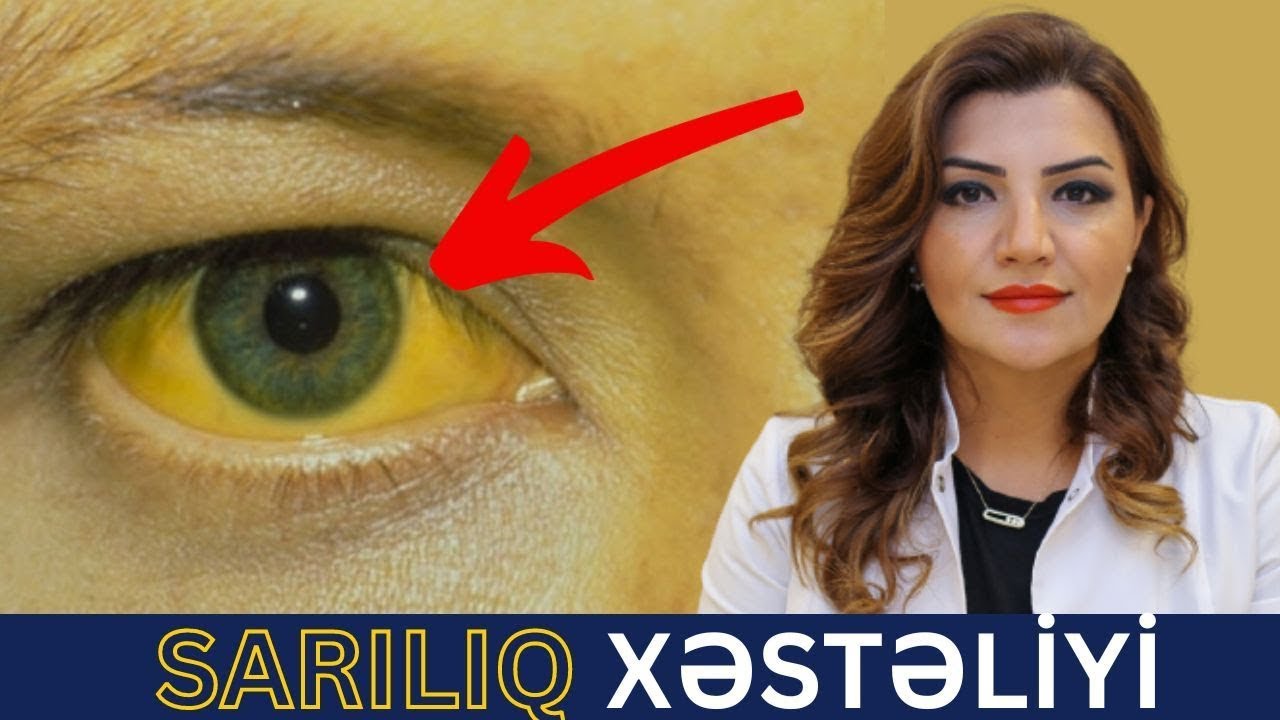 QAN XƏSTƏLİYİNİN əlaməti ola bilər! - Sarılıq xəstəliyi