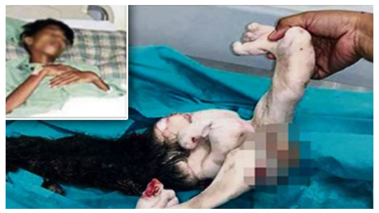 HEART- WRENCHING Cases of Parasitic Twins