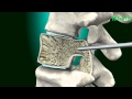 Vertebroplasty & Kyphoplasty ( Spine Surgery) Neuro Surgery; Fortis Healthcare,India