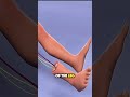 Limb Rotation Surgery for Bone Cancer (3D Animation)