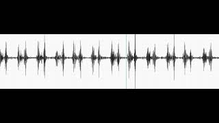 Tricuspid Regurgitation With Pulmonary Regurgitation 2