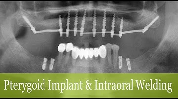 Pterygoid Implant & Intraoral Welding
